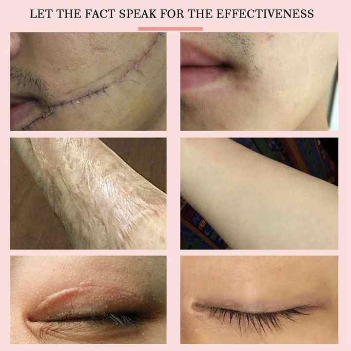 اطقم العنايه - زيت معدني مائي ينعم أنسجة الندبات