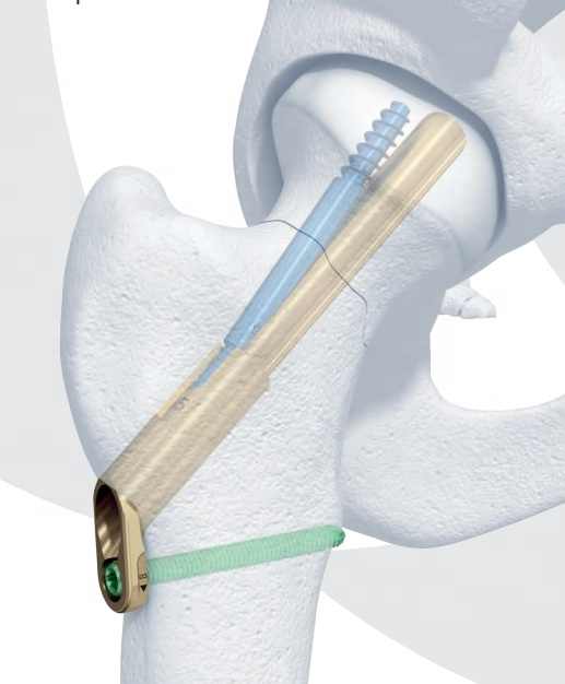 Screw for medical equipment set 