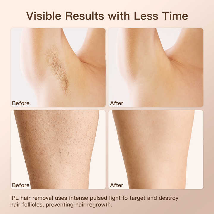 العنايه بالجسم -  أجهزة إزالة الشعر IPL